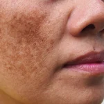 Melasma facial in Houston