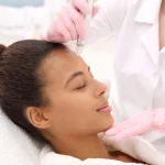 micro needling facial in Houston