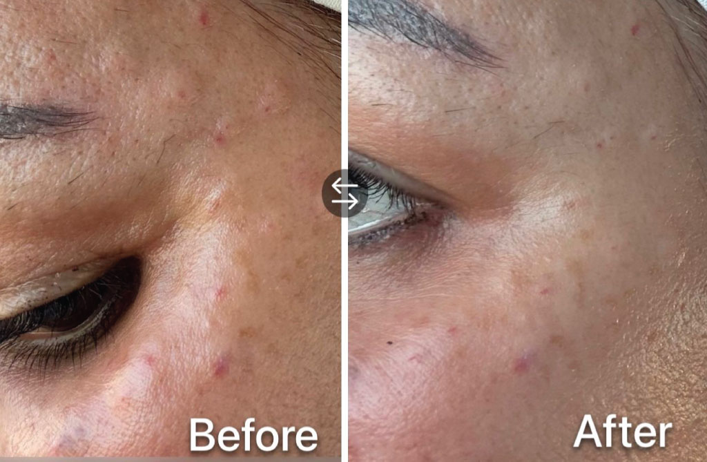 Mesobotox in our day spa in houston
